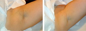 Laser Hair Removal for Women (Before & After)