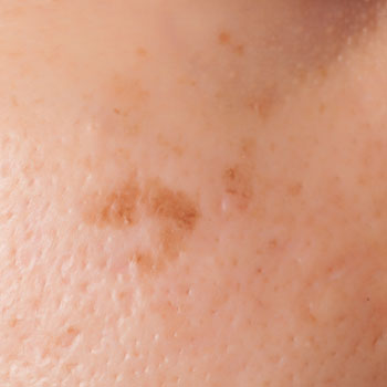 Pigmentation Blemishes